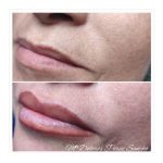 micropigmentación de labios