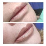 micropigmentación de labios
