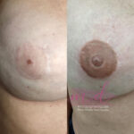 micropigmentación areolas en Barcelona