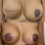 micropigmentación areolas en Barcelona