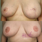 micropigmentación areolas en Barcelona