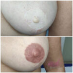 micropigmentación areolas en Barcelona
