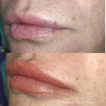 micropigmentación labios Barcelona