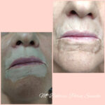 micropigmentacion vitiligo Barcelona-
