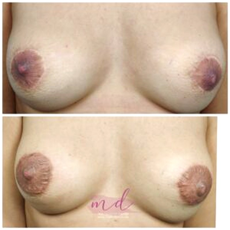 Areola_007