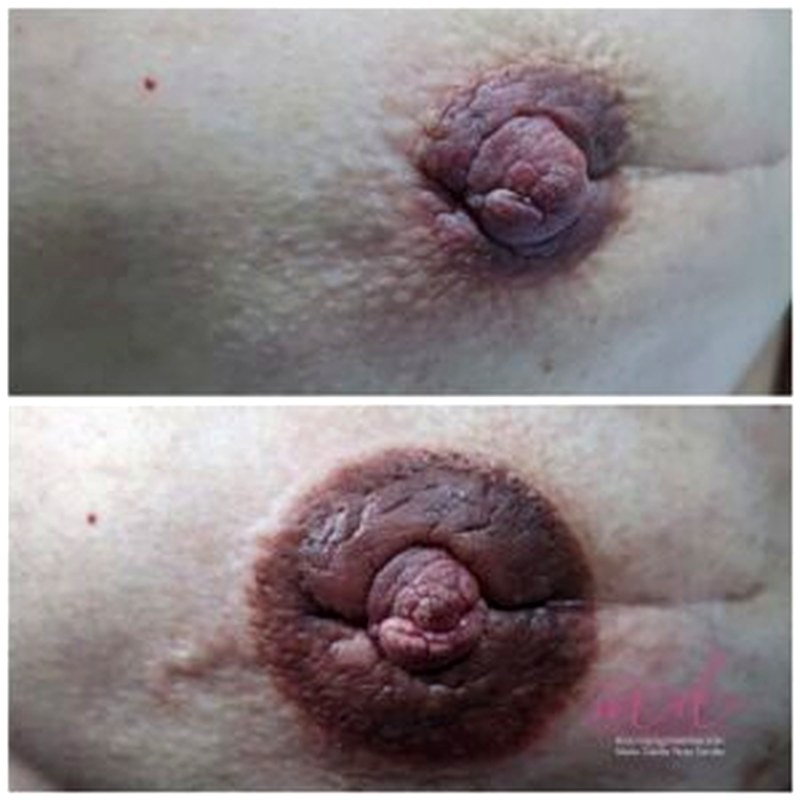 Areola_008