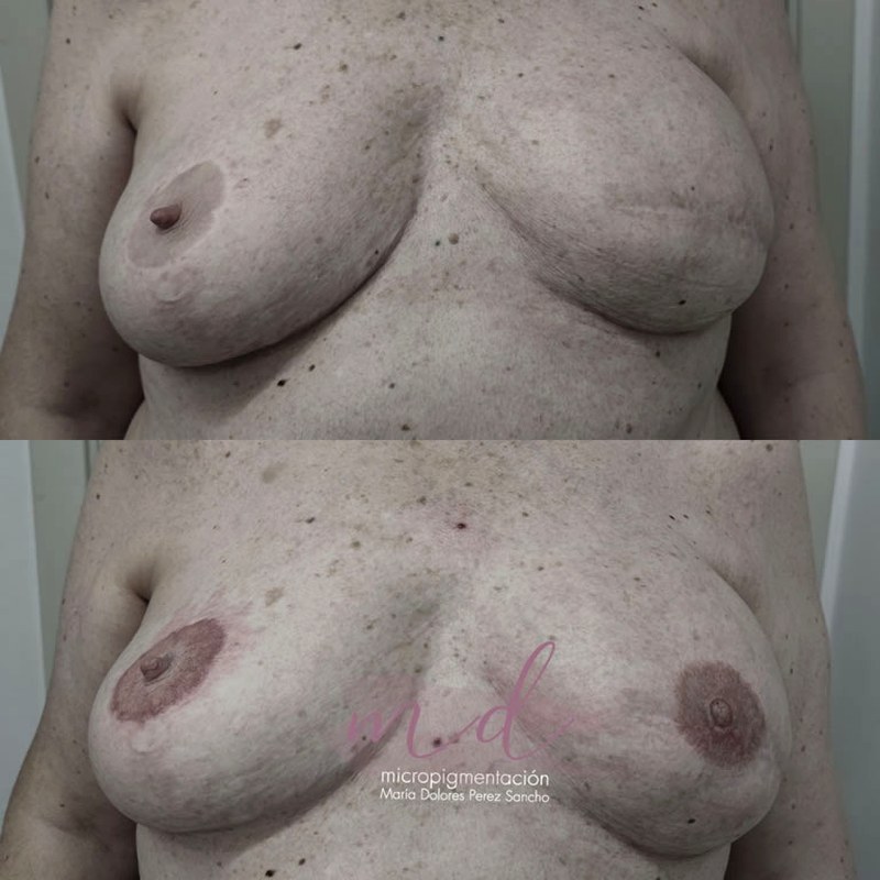 Areola_012