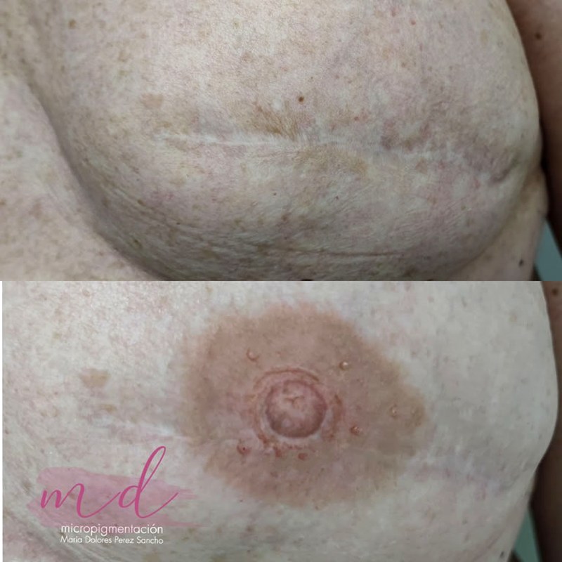 Areola_013