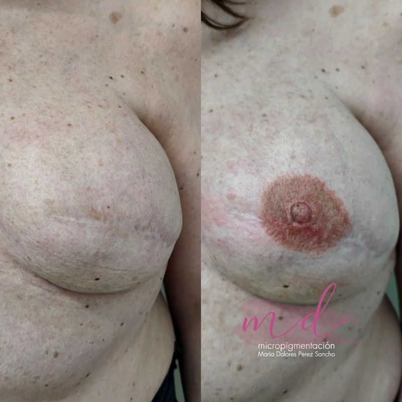 Areola_015