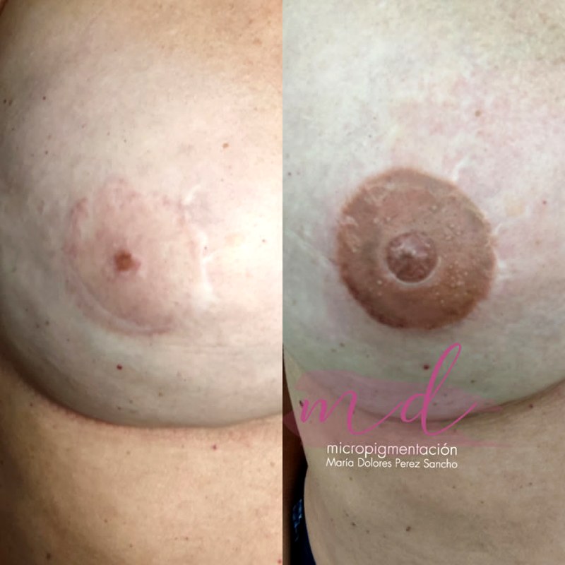 Areola_019
