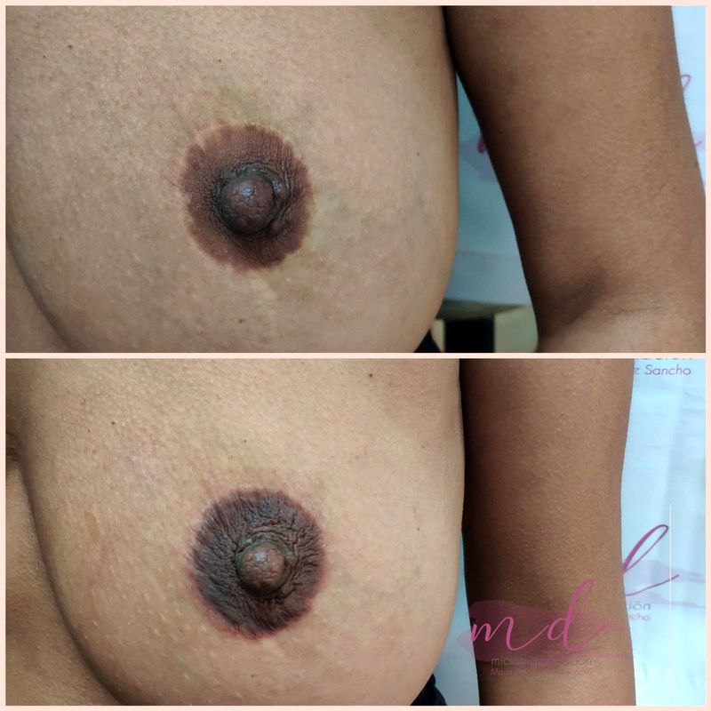 Areola_020