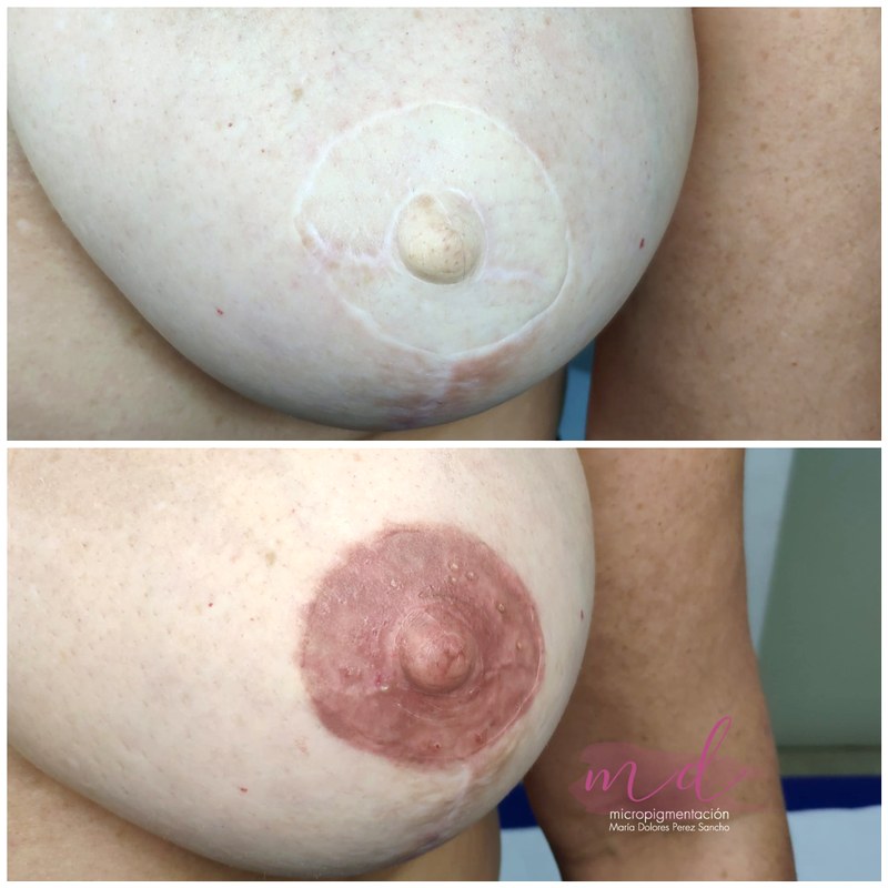 Areola_022