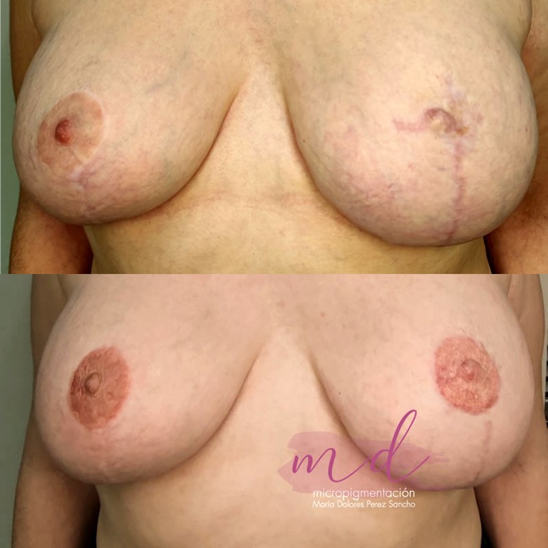 Areola_024