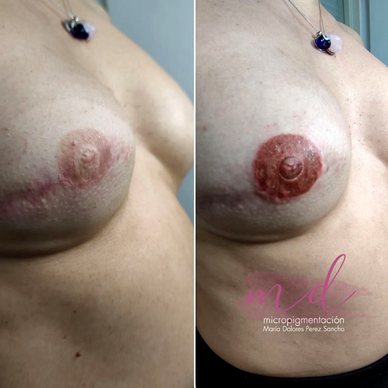 Areola_026