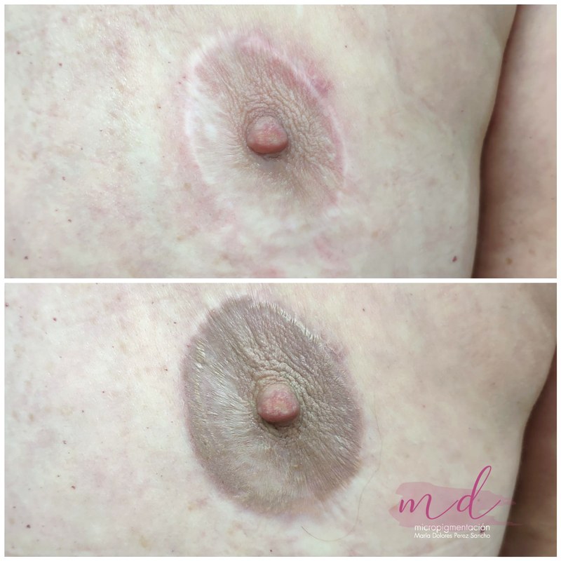 Areola_029