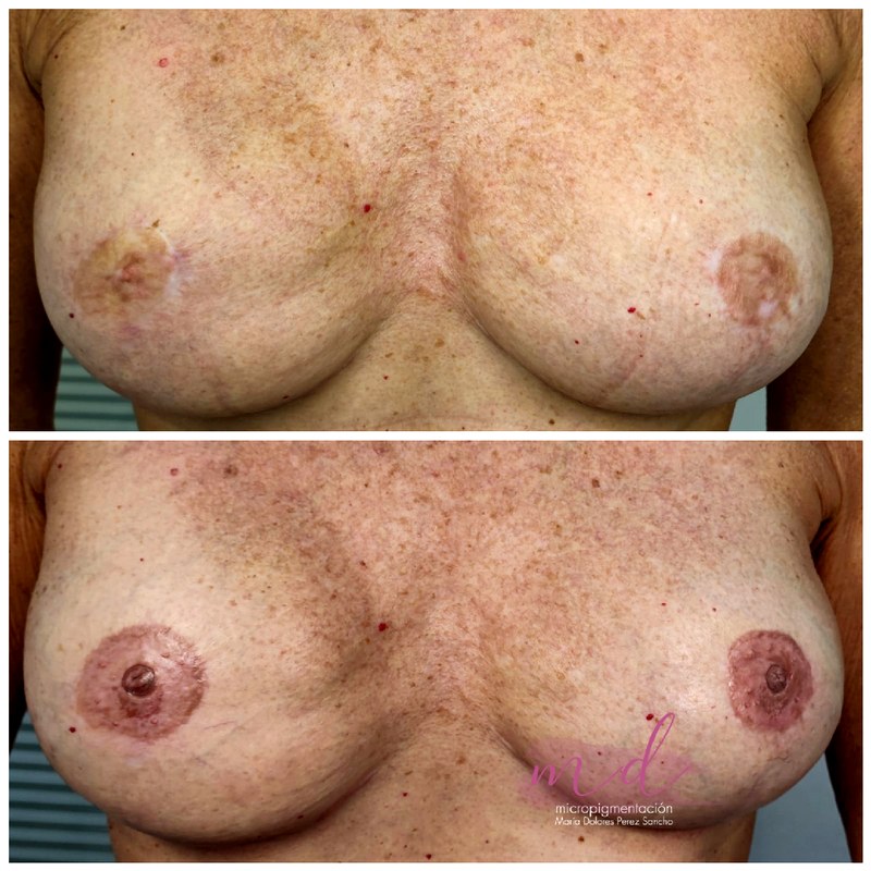 Areola_033