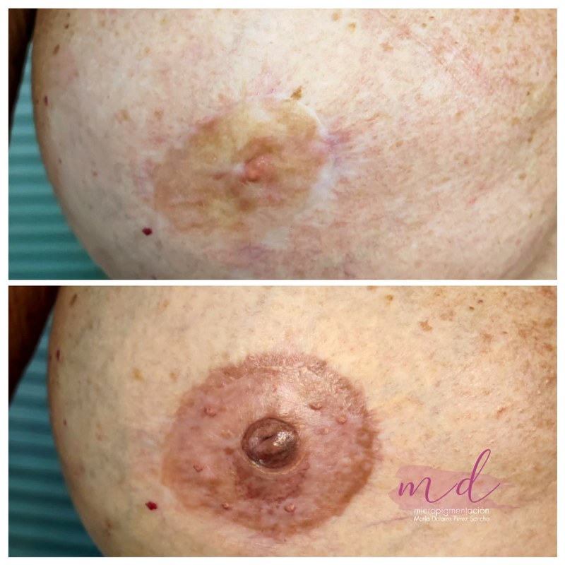 Areola_034