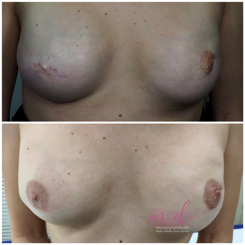 Areola_035