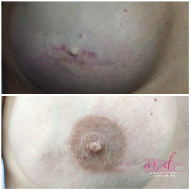 Areola_036
