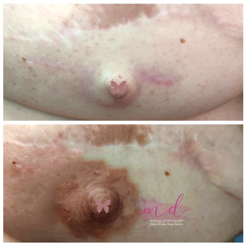 Areola_037