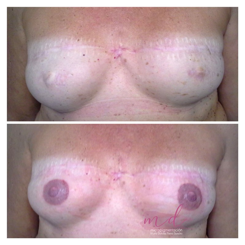Areola_039