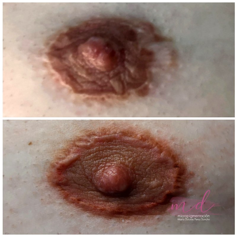 Areola_040