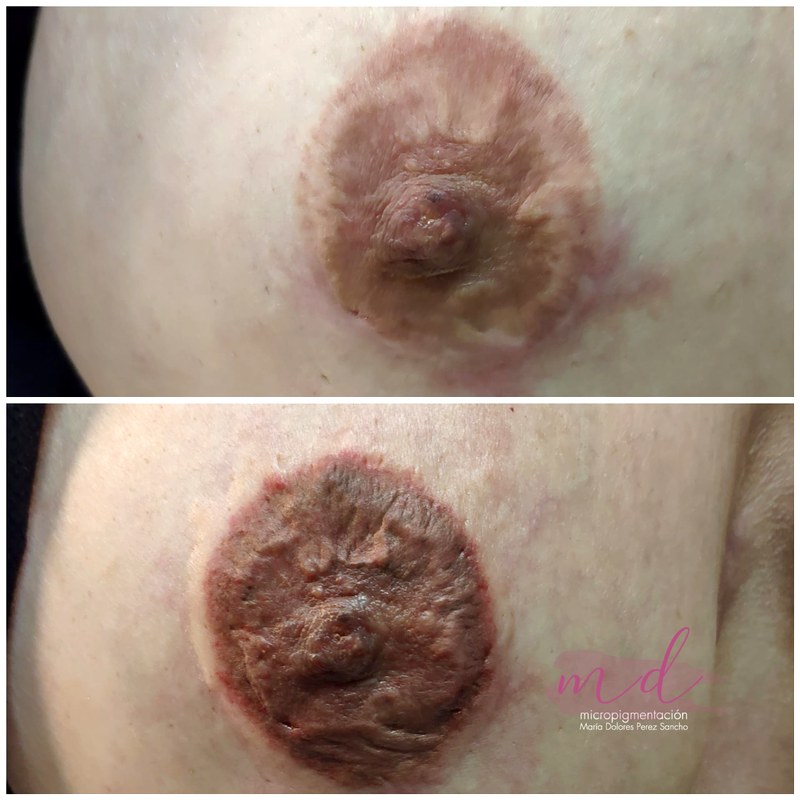 Areola_045