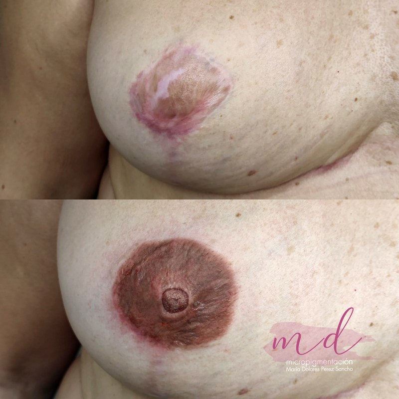 Areola_047