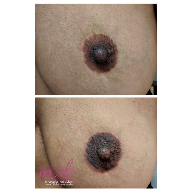 Areola_055