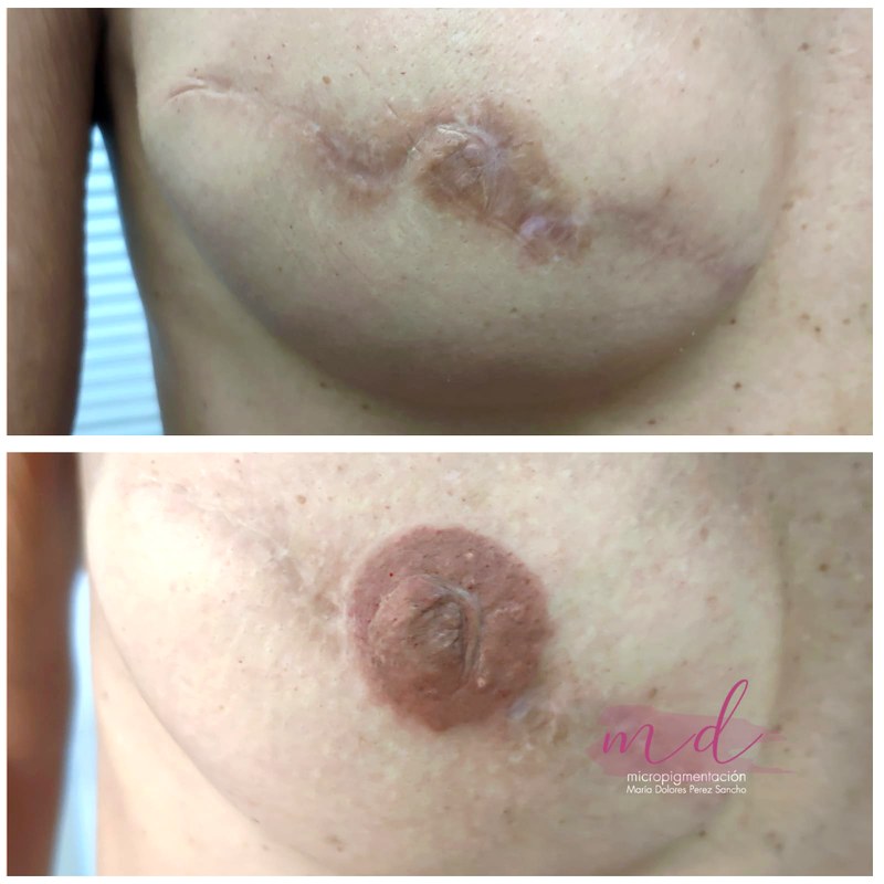 Areola_062