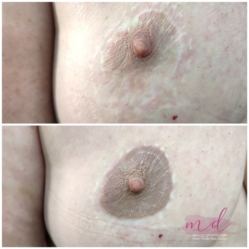Areola_063