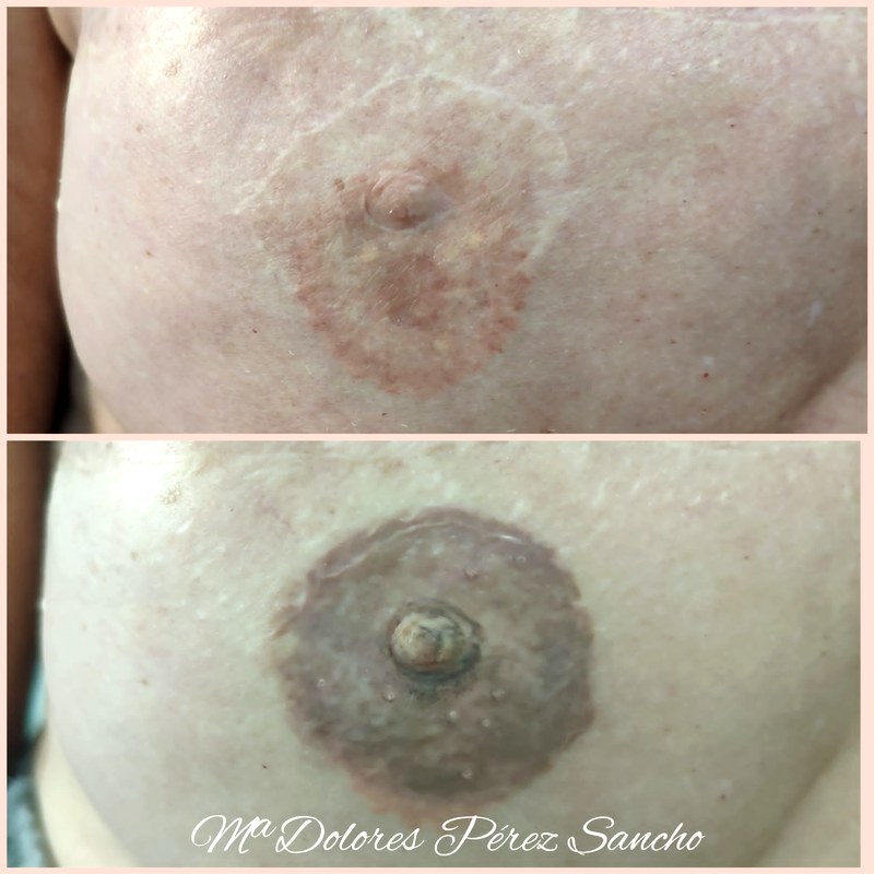 Areola_064