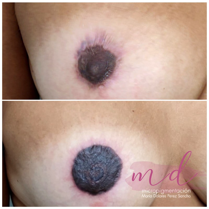 Areola_067