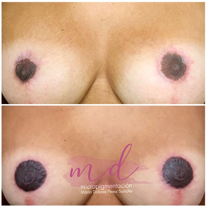 Areola_068