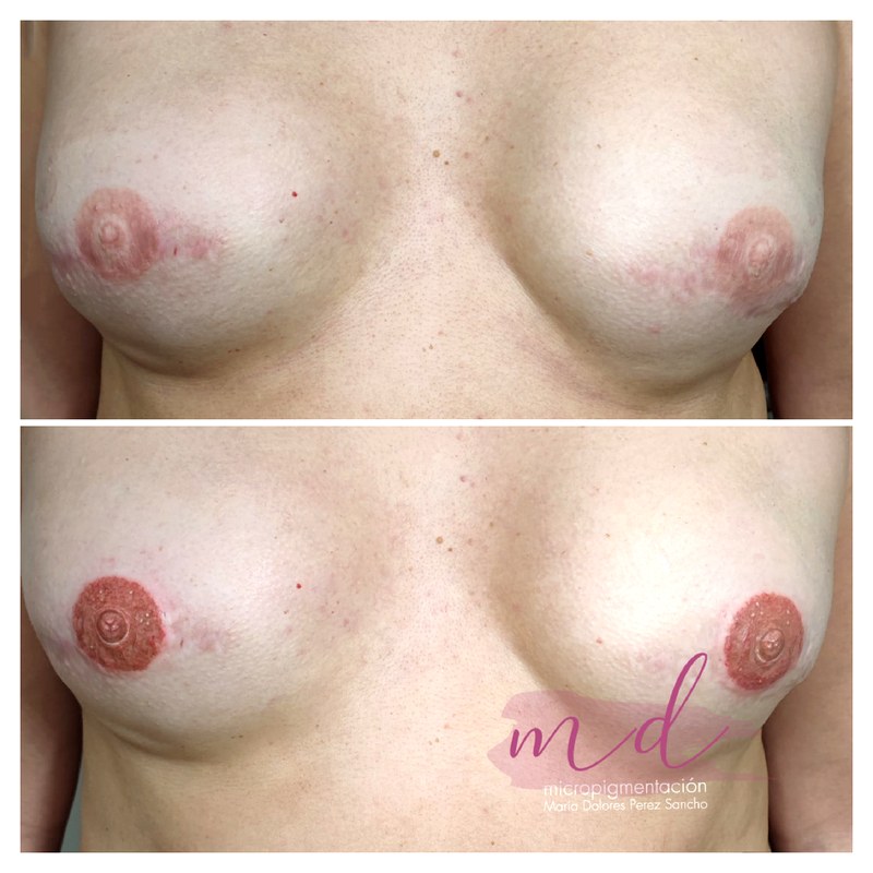 Areola_072
