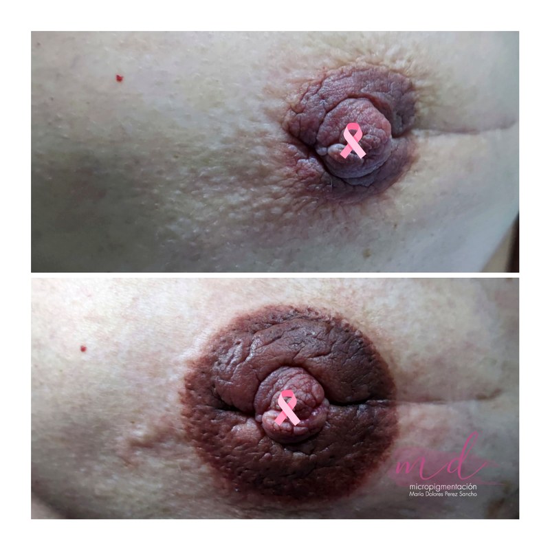 Areola_073