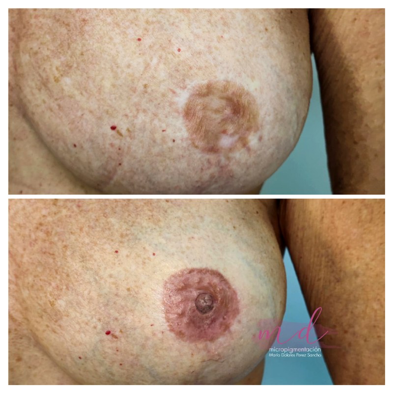 Areola_076