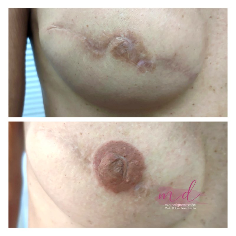 Areola_078