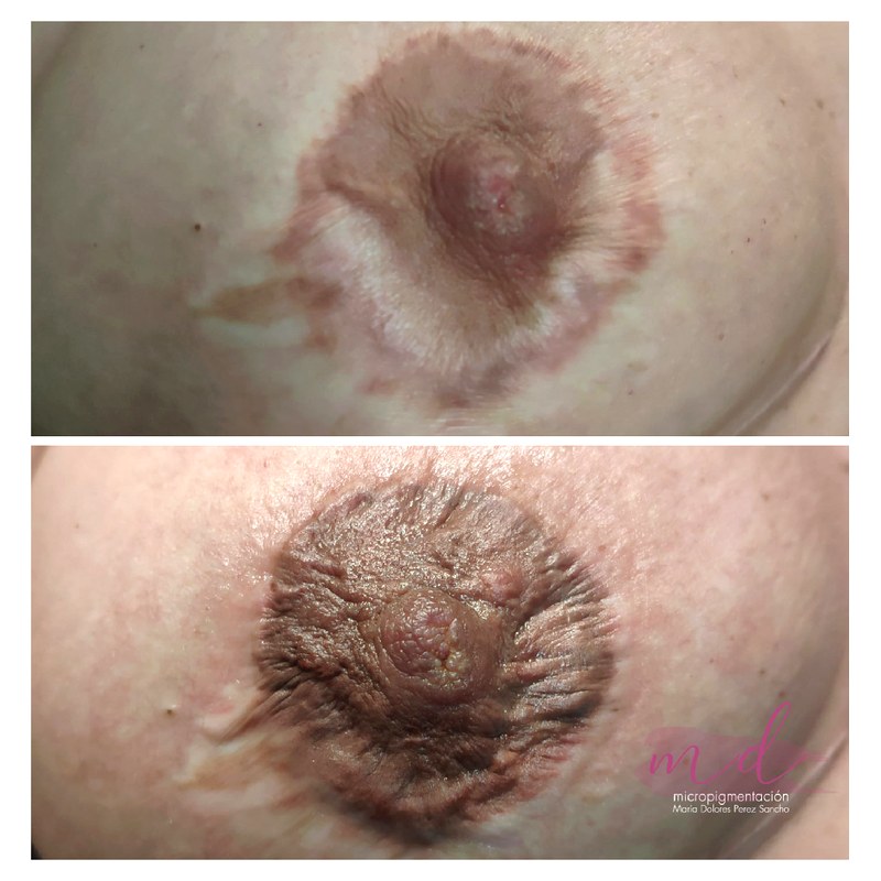 Areola_079