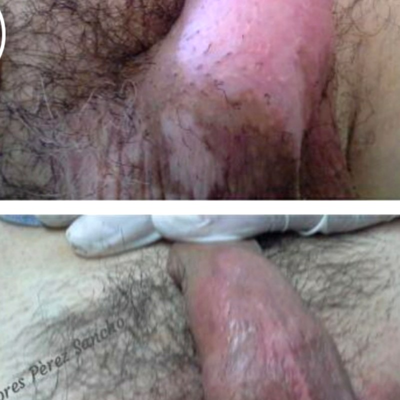 Vitiligo_005