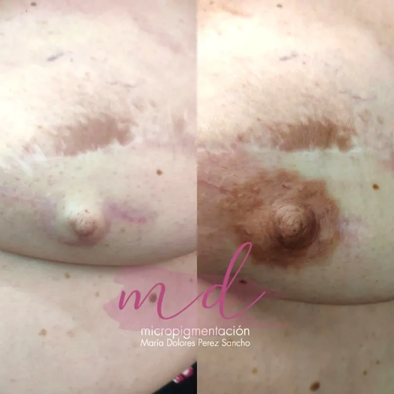 Reconstrucción areola y pezón resultado natural Barcelona