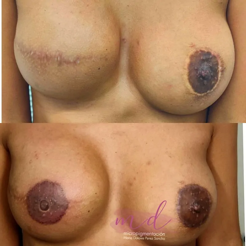 Micropigmentación areola oncológica antes y después Barcelona
