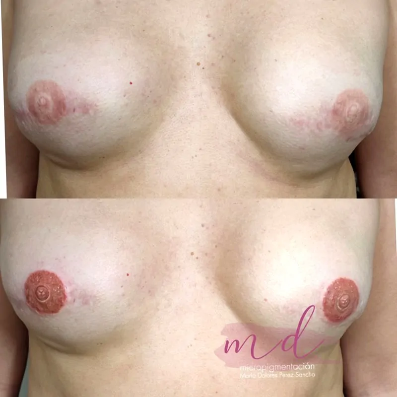 Reconstrucción areola bilateral micropigmentación Barcelona