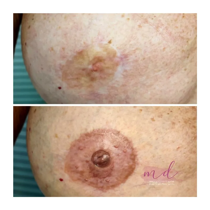 Micropigmentación areola Barcelona — reconstrucción tras mastectomía